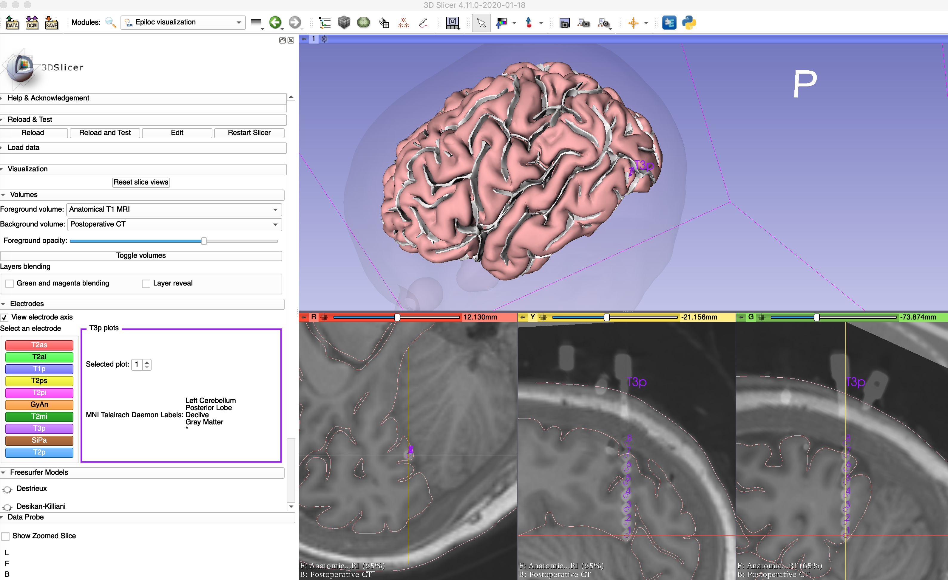 EpiLoc-View in 3D Slicer 4.11 - 1